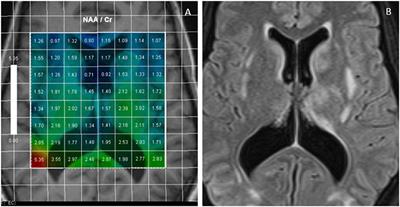 Advanced Imaging Techniques in Diagnosis of Posterior Reversible Encephalopathy Syndrome (PRES)